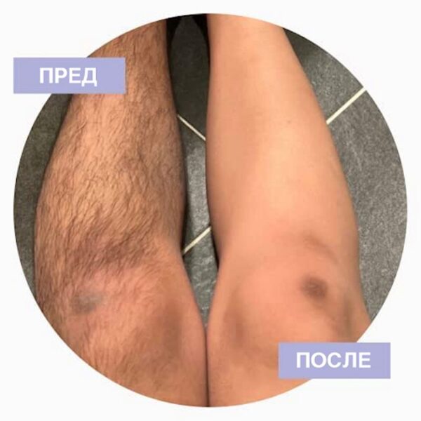 Нано Депилатор - Image 2